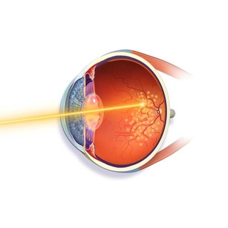 Green Laser For Diabetic Retinopathy – eye2heartcare.com